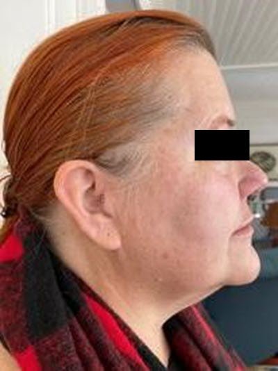 Botox and Filler Treatment - After