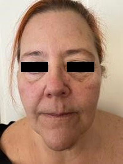 Botox and Filler Treatment - Before