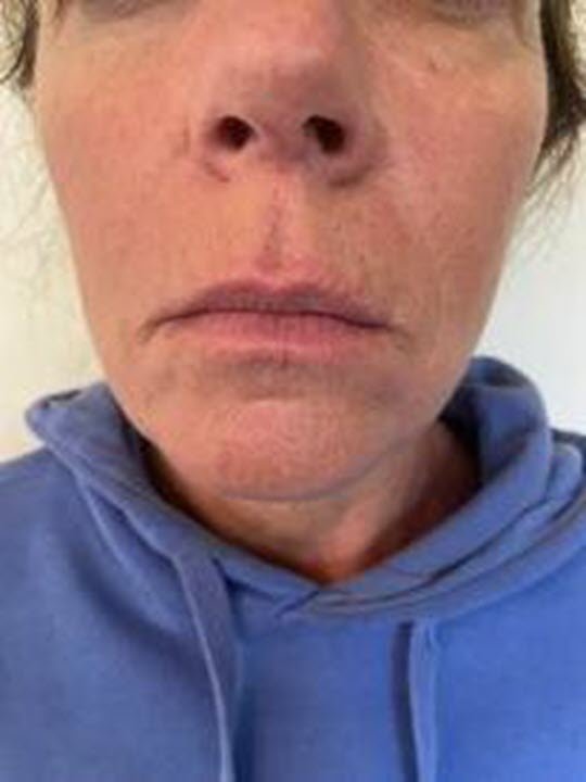 Botox After